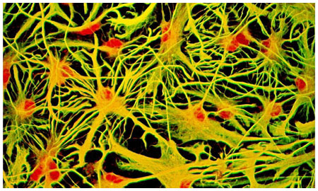 accumulo cerebrale ferro dieta ipocalorica